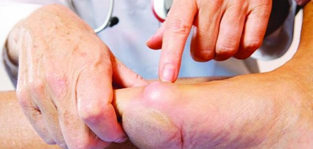 البروز العظمي في القدم