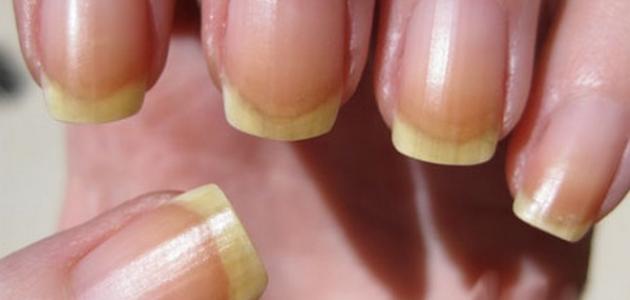 أضرار طلاء الأظافر