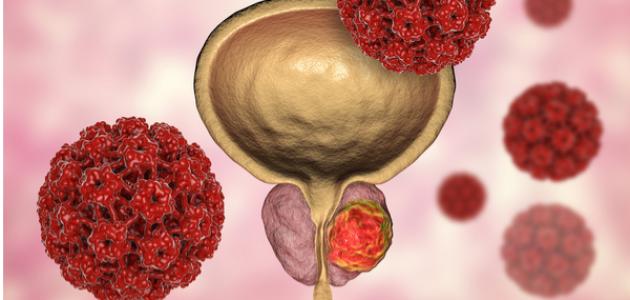 دراسة...هذا النوع من الأطعمة يحفز نمو سرطان البروستاتا