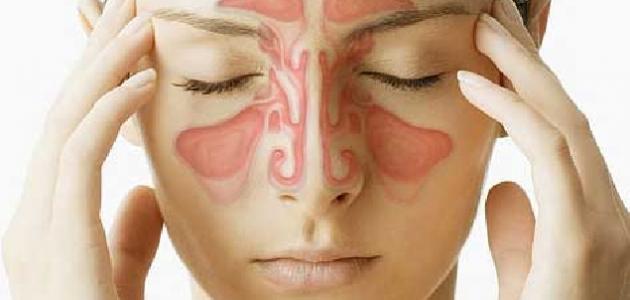 التهاب الجيوب الأنفية 