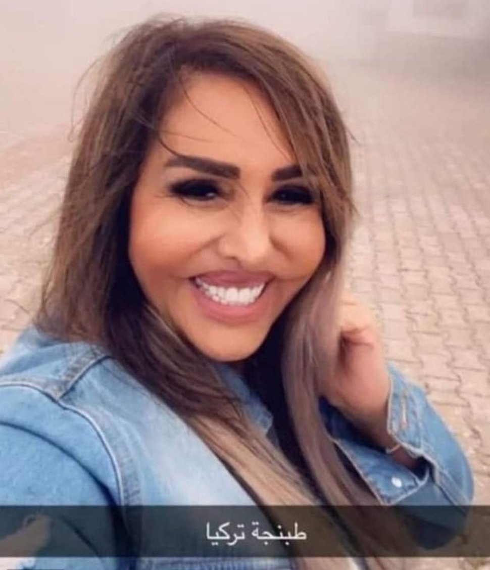 مها المصري بعد عمليات التجميل