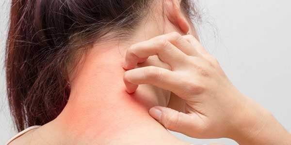 هل يعد الطفح الجلدي علامة من علامات الإصابة بكوفيد-19؟