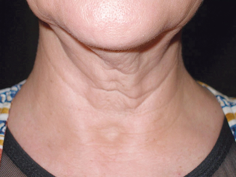 اضرار الاستخدام المفرط للهاتف على البشرة