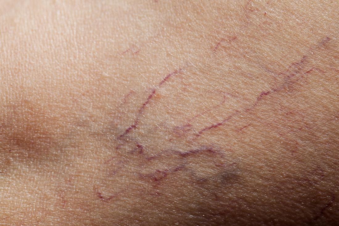 التهاب الكبد الوبائي C