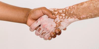 البهاق.. انواعه وهل هو معدي؟