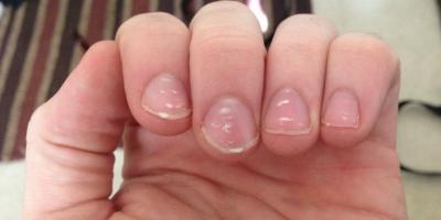 أسباب ظهور البقع البيضاء على الأظافر.. تعرفي عليها