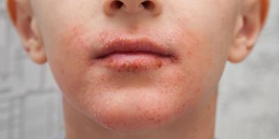 ماذا عن الصدفية على الشفاه أو حولها؟ إليك ما تحتاجين معرفته