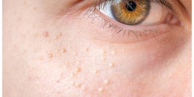 علاجات منزلية فعالة للتخلص من حبوب الميليا بالوجه