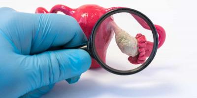 رجيم تكيس المبايض