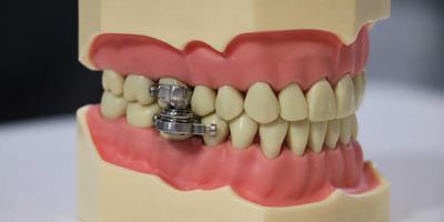  باحثون يطورون جهازاً غير تقليدي لإنقاص الوزن عن طريق قفل الأسنان معاً