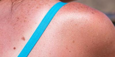 هل يمكنكِ علاج أضرار الشمس التي أصيبت بها في وفت سابق؟