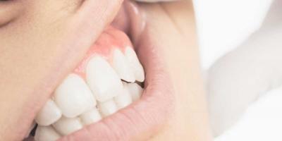 ما هي أسباب التجاويف التي تحدث بالقرب من خط اللثة وكيف يتم علاجها؟