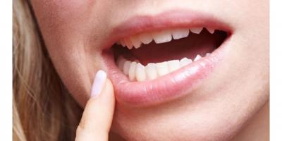 خرافات شائعة عن سرطان الفم لا تنساقوا ورائها