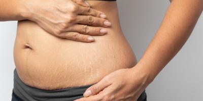 تعرفي على أفضل الطرق لإزالة علامات التمدد في الجلد بعد الولادة