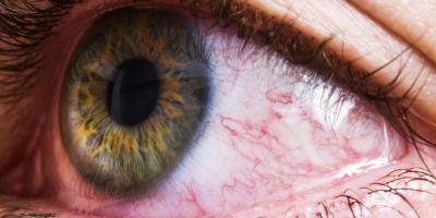 4 نصائح بسيطة لتخفيف التهابات العين الوردية.. تعرف عليها 