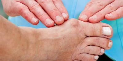 البروز العظمي في القدم