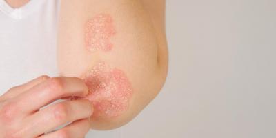10 طرق لعلاج الصدفية في المنزل