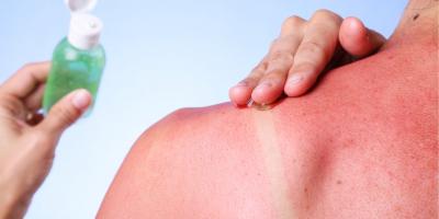 علاجات منزلية لمعالجة أضرار أشعة الشمس على البشرة والشعر