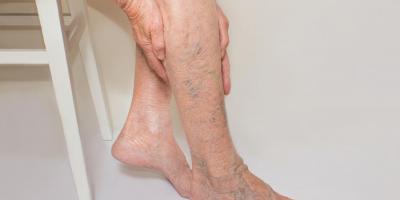  أعشاب طبيعية لعلاج دوالي الساقين