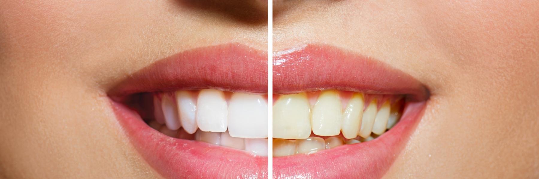 الأسنان الصفراء