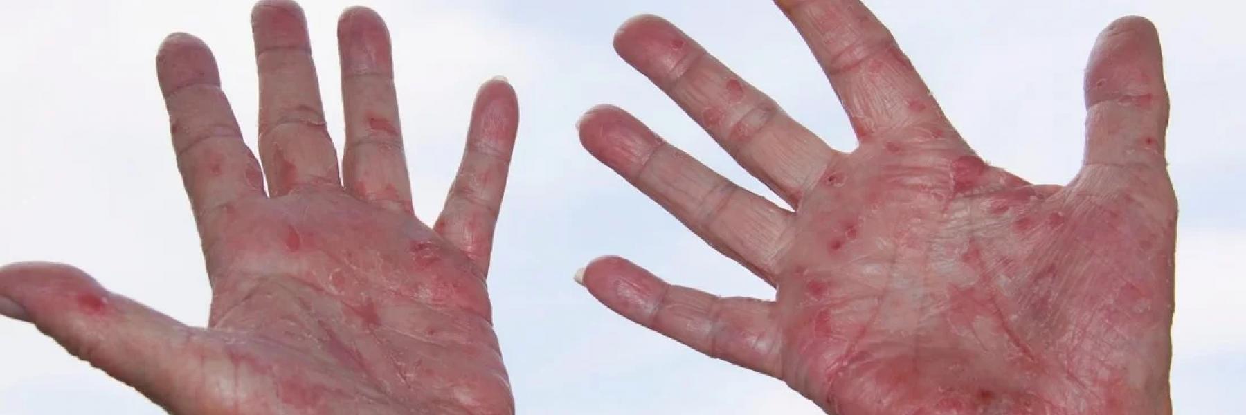 هل الاكزيما علامة على ضعف جهاز المناعة؟