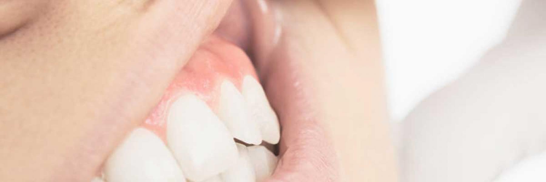 ما هي أسباب التجاويف التي تحدث بالقرب من خط اللثة وكيف يتم علاجها؟