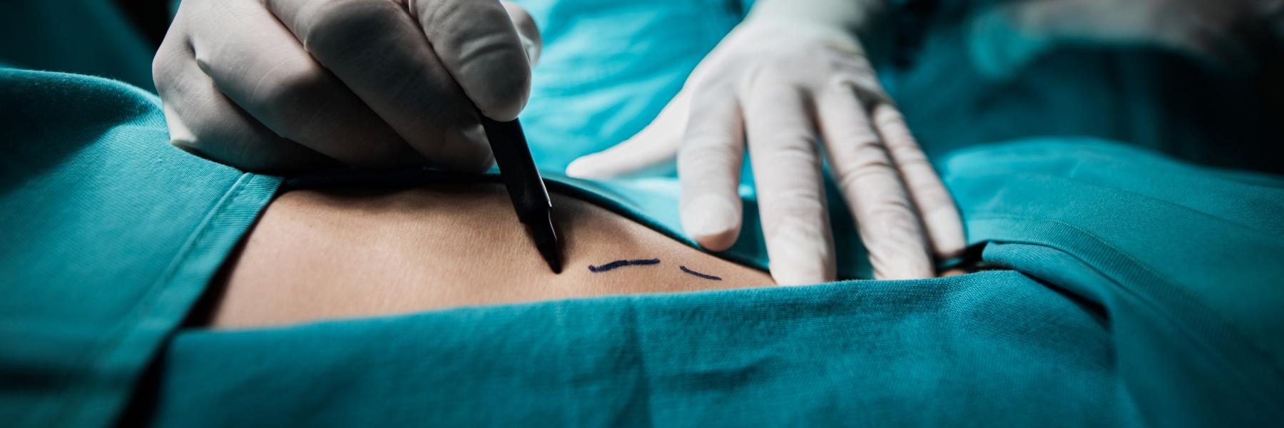 ابتكار كاميرا لتصوير الأورام السرطانية خلال الجراحة