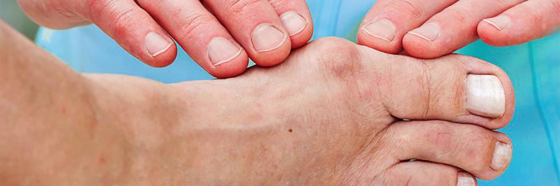 البروز العظمي