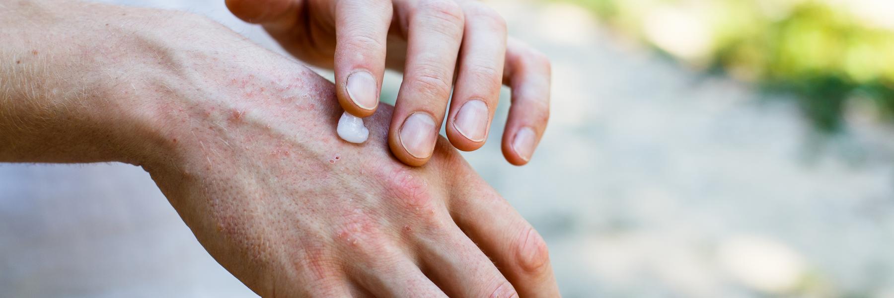 الصدفية: أسئلة مكررة، وشائعات شائعة