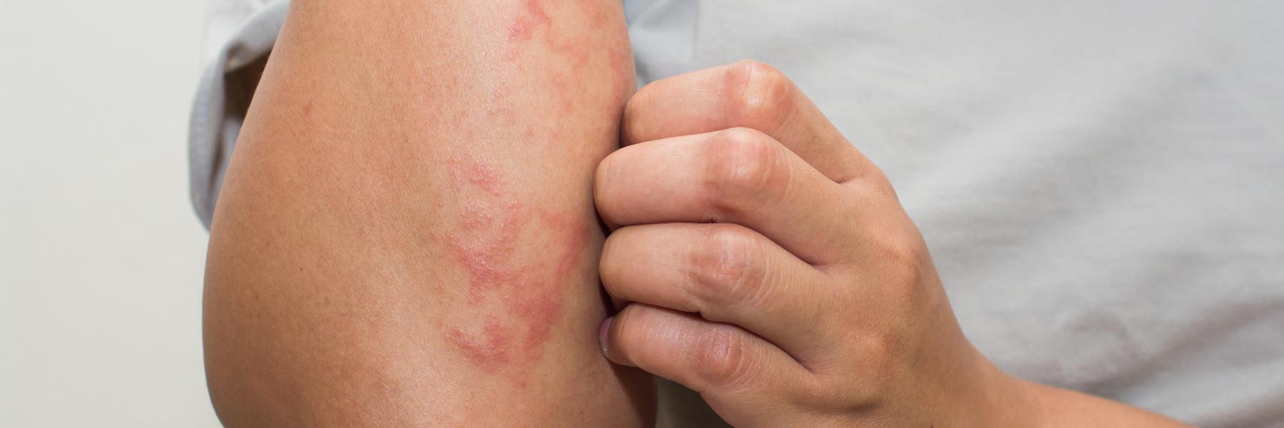 الأكزيما الدهنية: الأسباب، الأعراض، العلاج