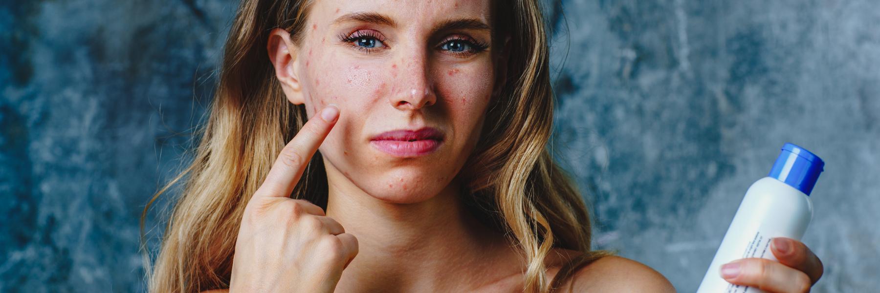 7 أخطاء للعناية بالبشرة يمكن أن تسبب لك حب الشباب