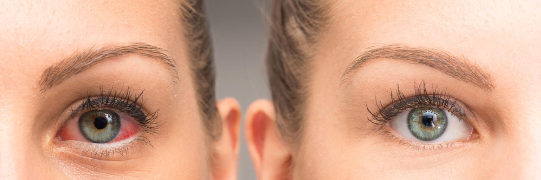 التهاب القزحية