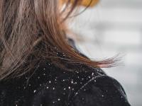 1- يحارب قشرة الشعر يساعد حليب جوز الهند على إبادة الفطريات والبكتيريا التي تستوطن فروة الرأس وتسبب قشرة الشعر، وبالتالي يعالج القشرة ويمنع تشكلها على فروة الرأس بدون أن يتسبب بجفاف الشعر وتلفه.