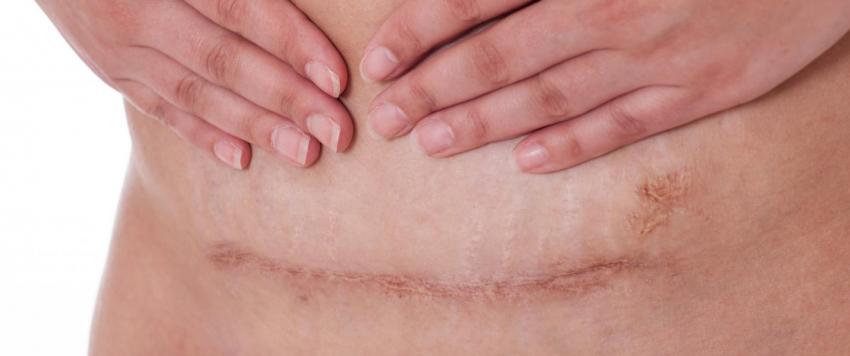 اعرفي كيف تتخلصين من تورم عضلات البطن بعد القيصرية