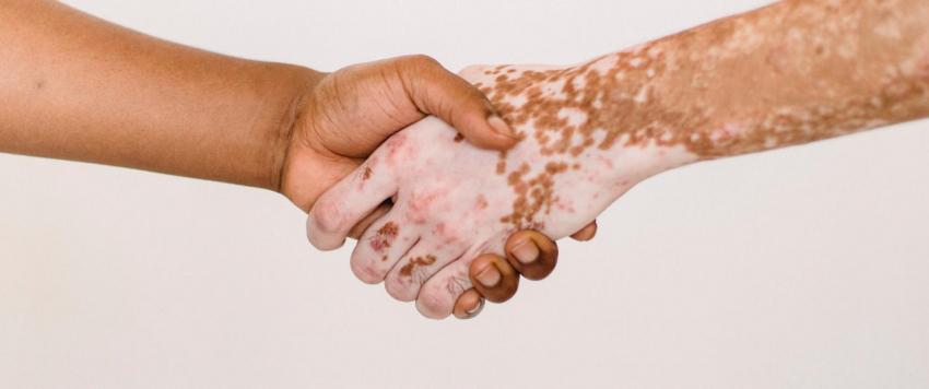 البهاق.. انواعه وهل هو معدي؟