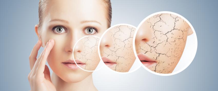 جفاف البشرة