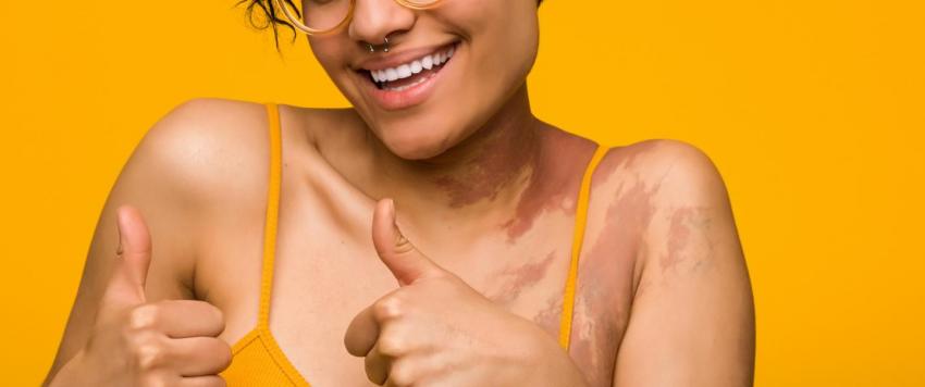 الوحمات: الأنواع والخرافات