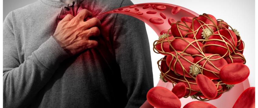 انسداد الشرايين