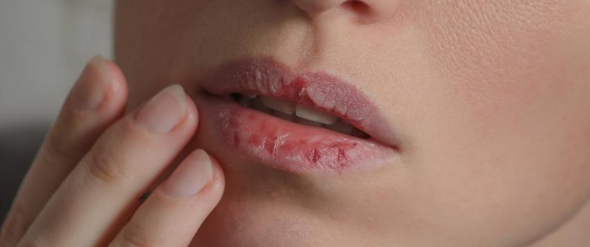 تقرحات الفم