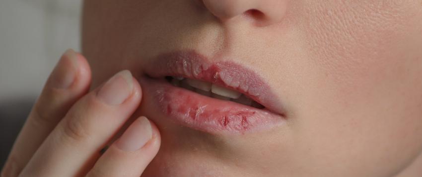 تقرحات الفم