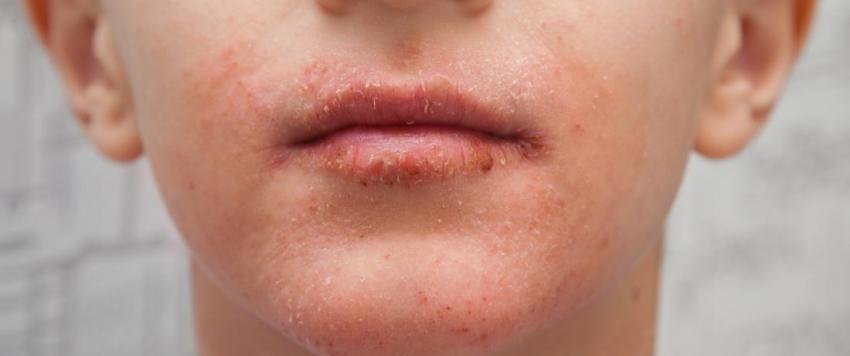 الاصدفية حول الفم