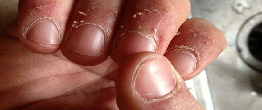 تقشر الأظافر