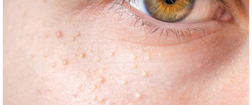 حبوب الميليا