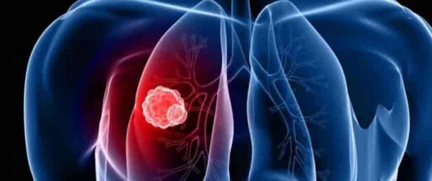 سرطان الرئة