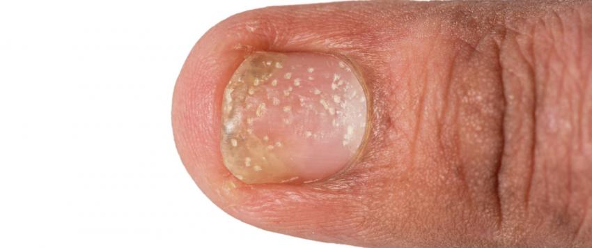 طرق منزلية تساعد علي الوقاية من صدفية الأظافر