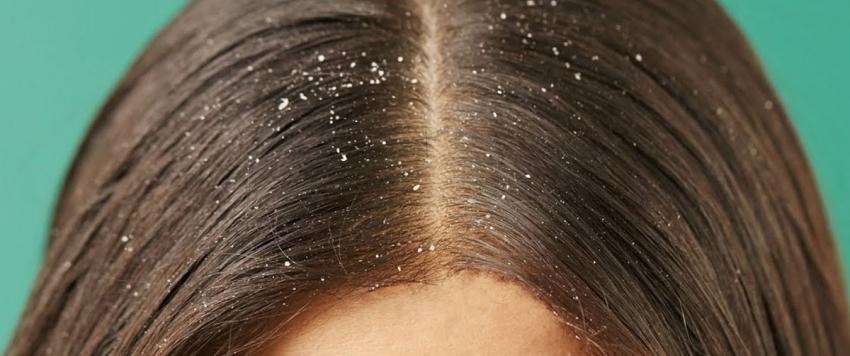 ظهور قشرة الشعر: الأسباب، الأعراض، طرق العلاج