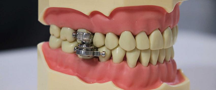 قفل الأسنان