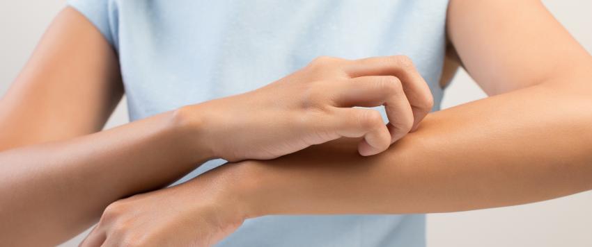 لدغة البعوض