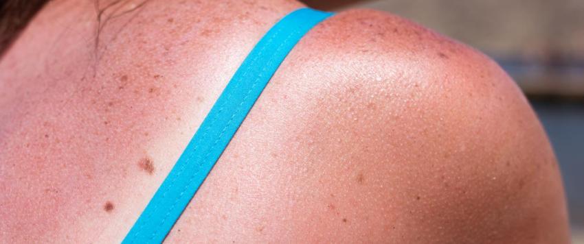 هل يمكنكِ علاج أضرار الشمس التي أصيبت بها في وفت سابق؟