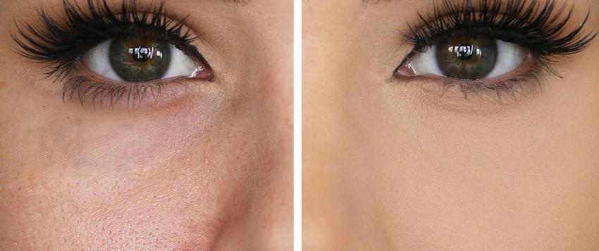 مسامات الوجه